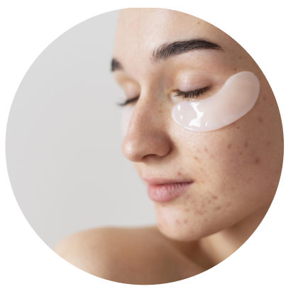 přírodní péče o akné