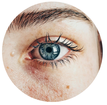 retinoidy a chemický peeling a podráždění pleti